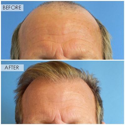 BEFORE AFTERS Neograft Hair Restoration Orange County