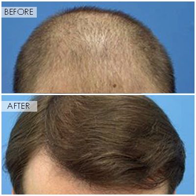 Hair-Transplant-Orange-County