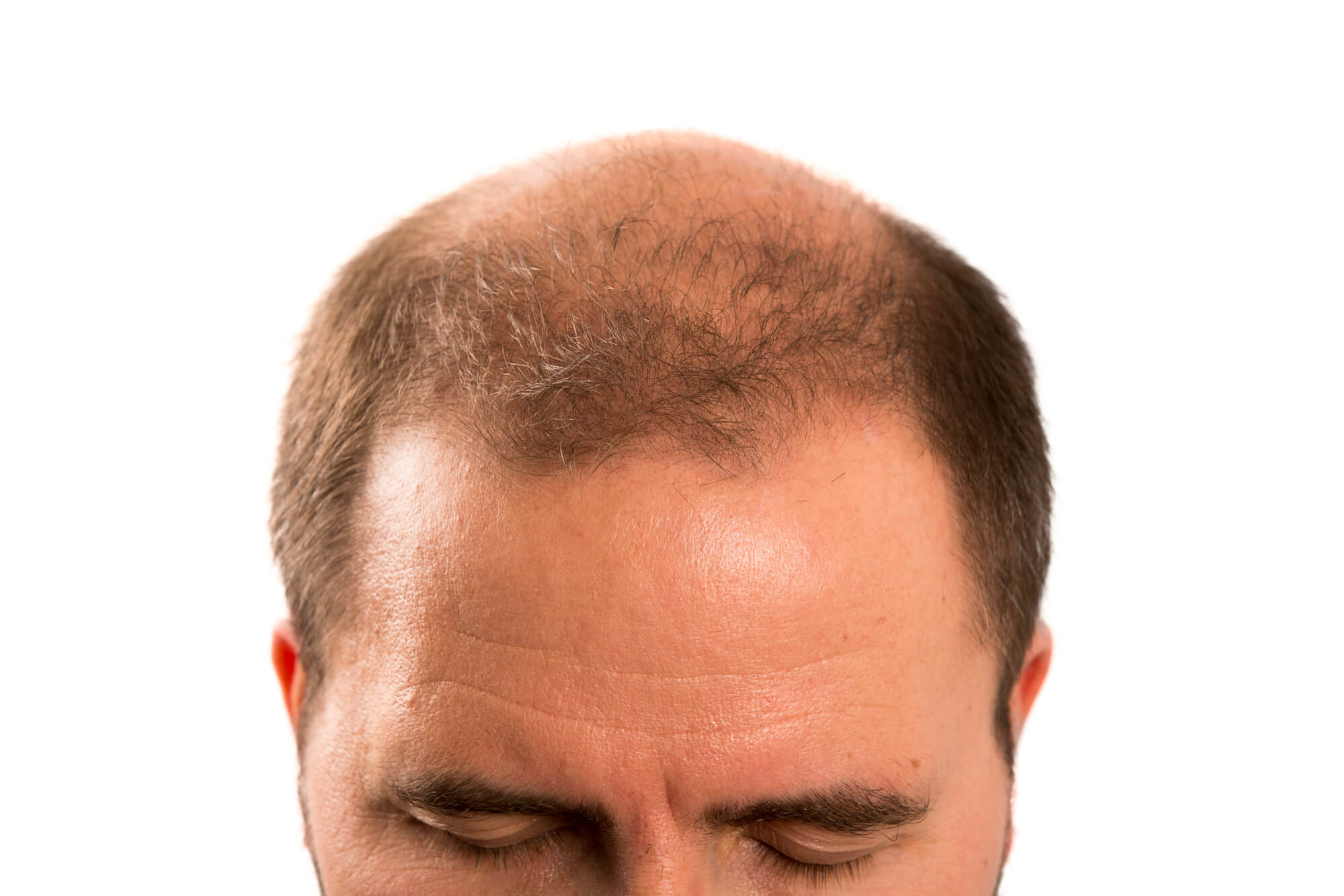 Newport Beach Thinning Hair Treatment provides effective solutions to combat hair loss, helping you restore volume and confidence with personalized care.