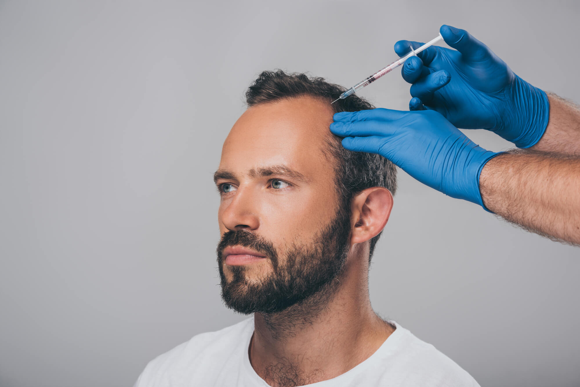 treatment for baldness Newport Beach