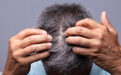 Can Dandruff Cause Hair Loss