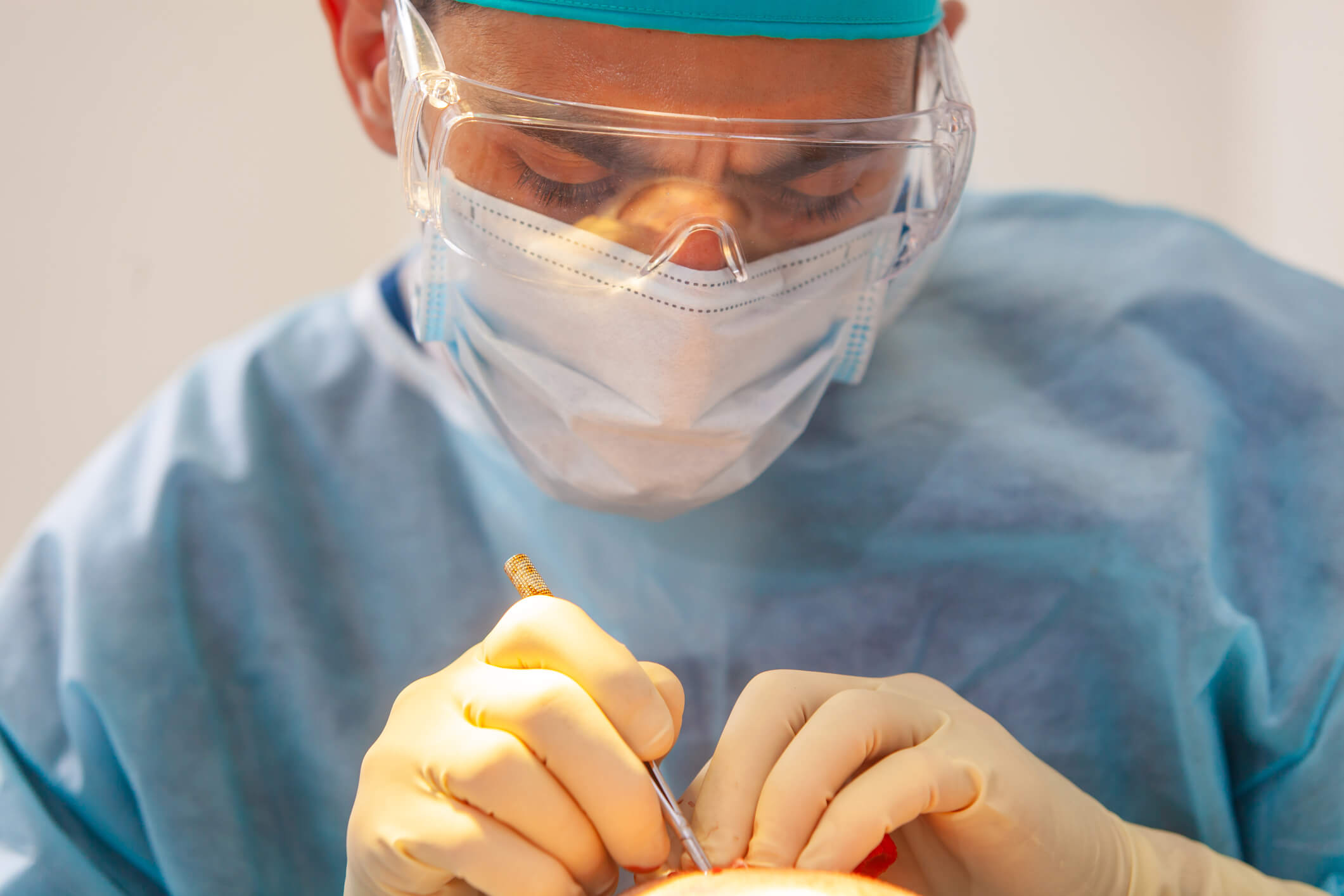 A client at Neograft Hair Restoration Orange County recieving hair transplant to a professional using a small tool in a sterile environment in Newport Beach, California