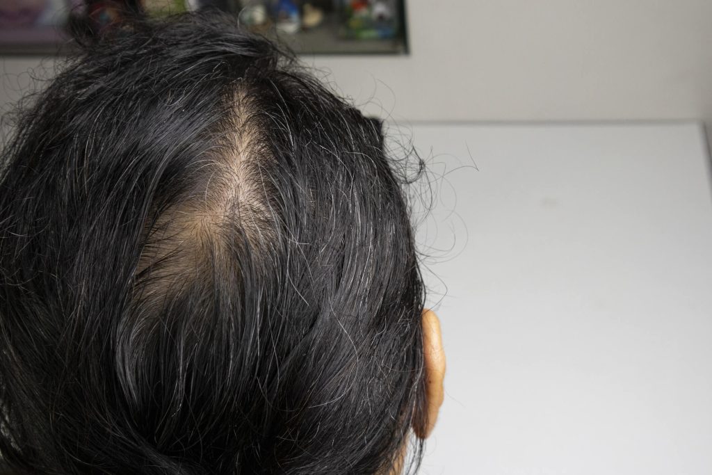 Does Picking at Your Scalp Cause Hair Loss In Orange County