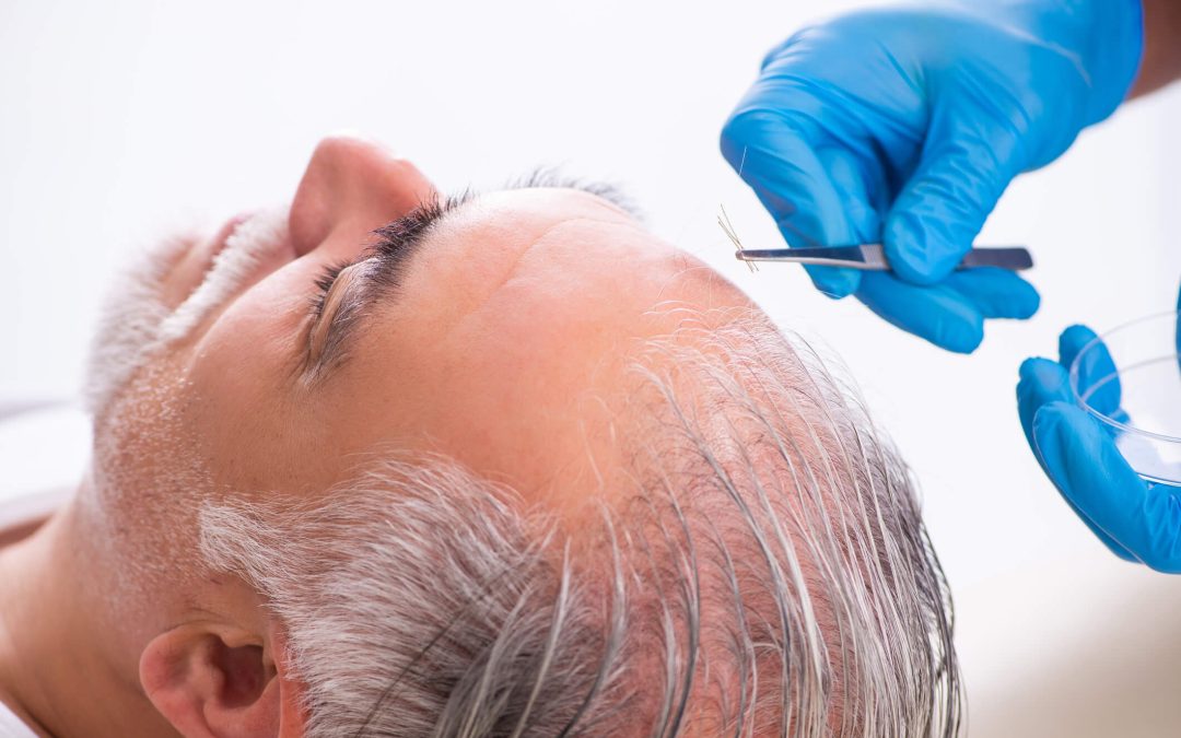 Hair Transplant Recovery Timeline