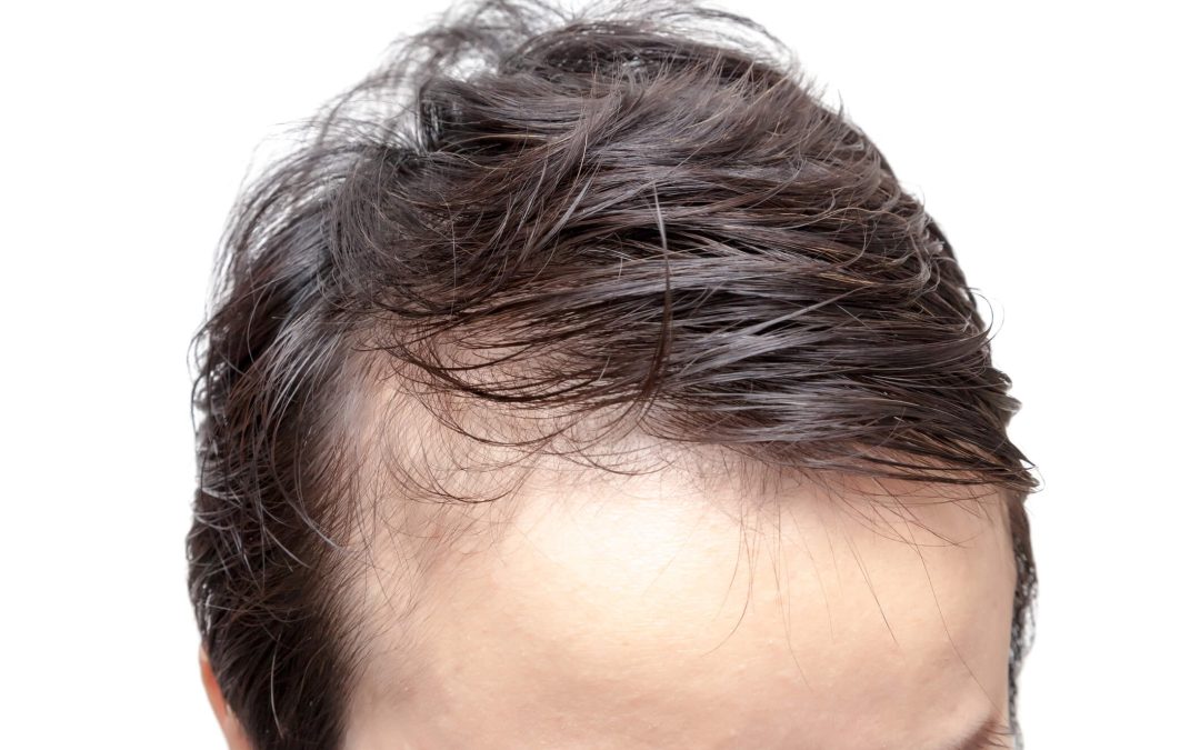 Is It Worth Getting a Hair Transplant if You Have a Receding Hairline?