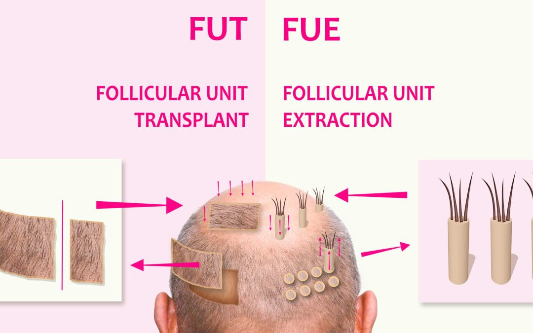 FUE vs FUT Hair Transplant: Which is Right for You?