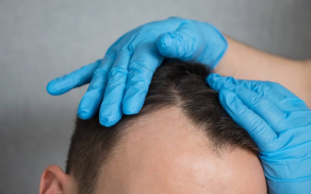 What Is The Best Age To Get A Hair Transplant