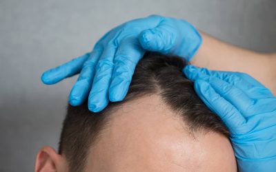 What Is The Best Age To Get A Hair Transplant?