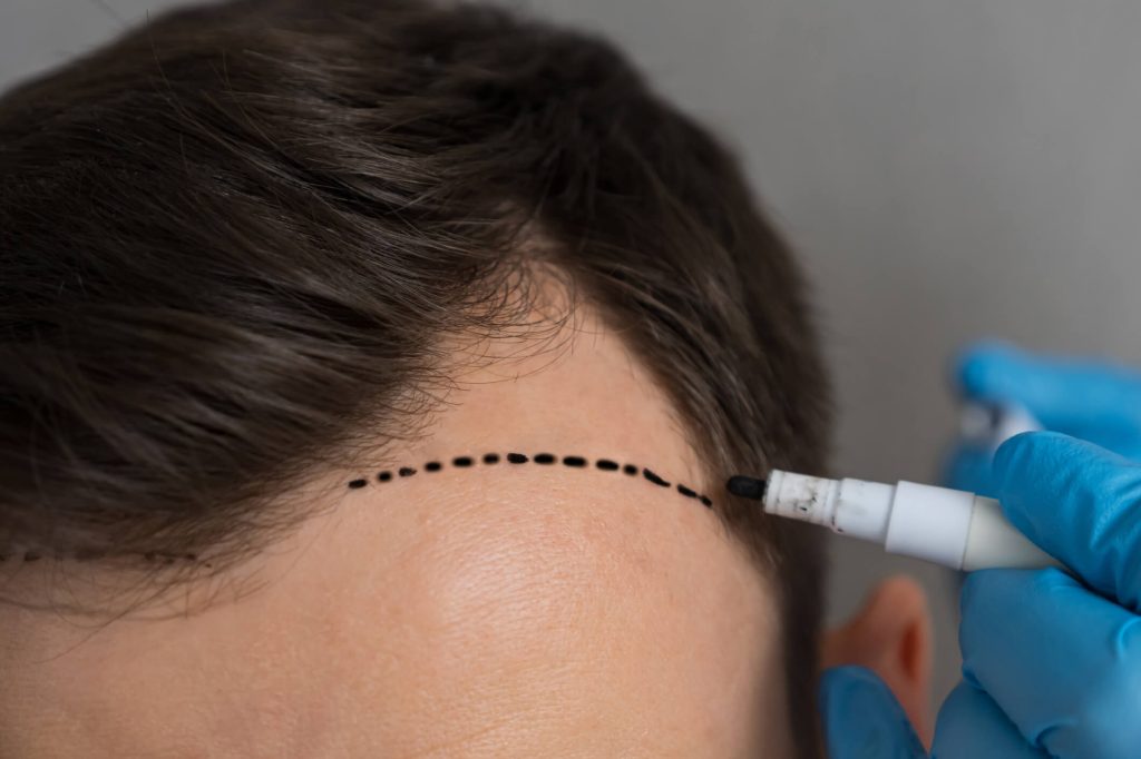 What Is The Best Age To Get A Hair Transplant In Orange County