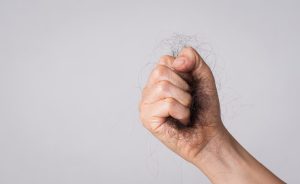 What Is Hair Loss?