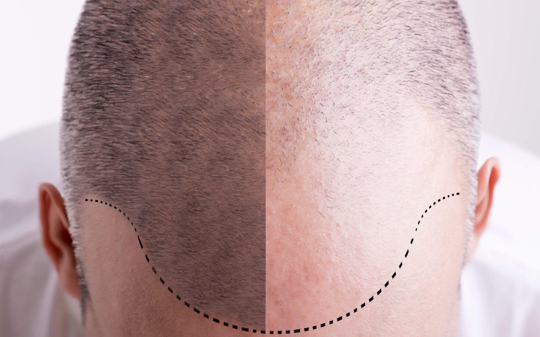 Hair Transplant Timeline: What to Expect