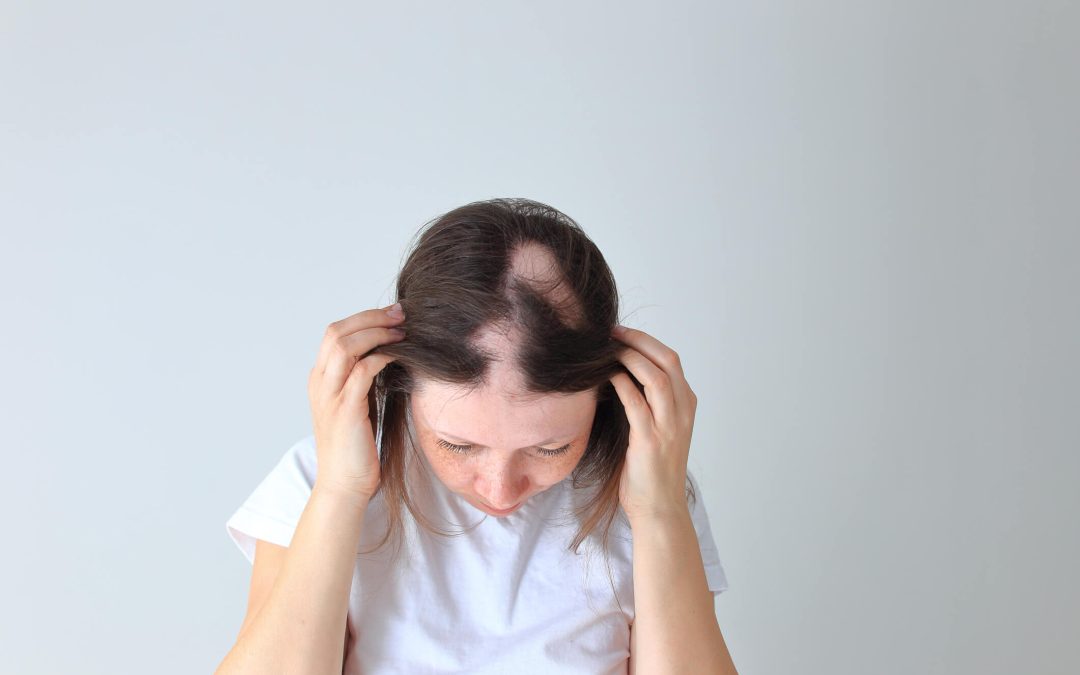 Things to Avoid When You Have Alopecia Areata