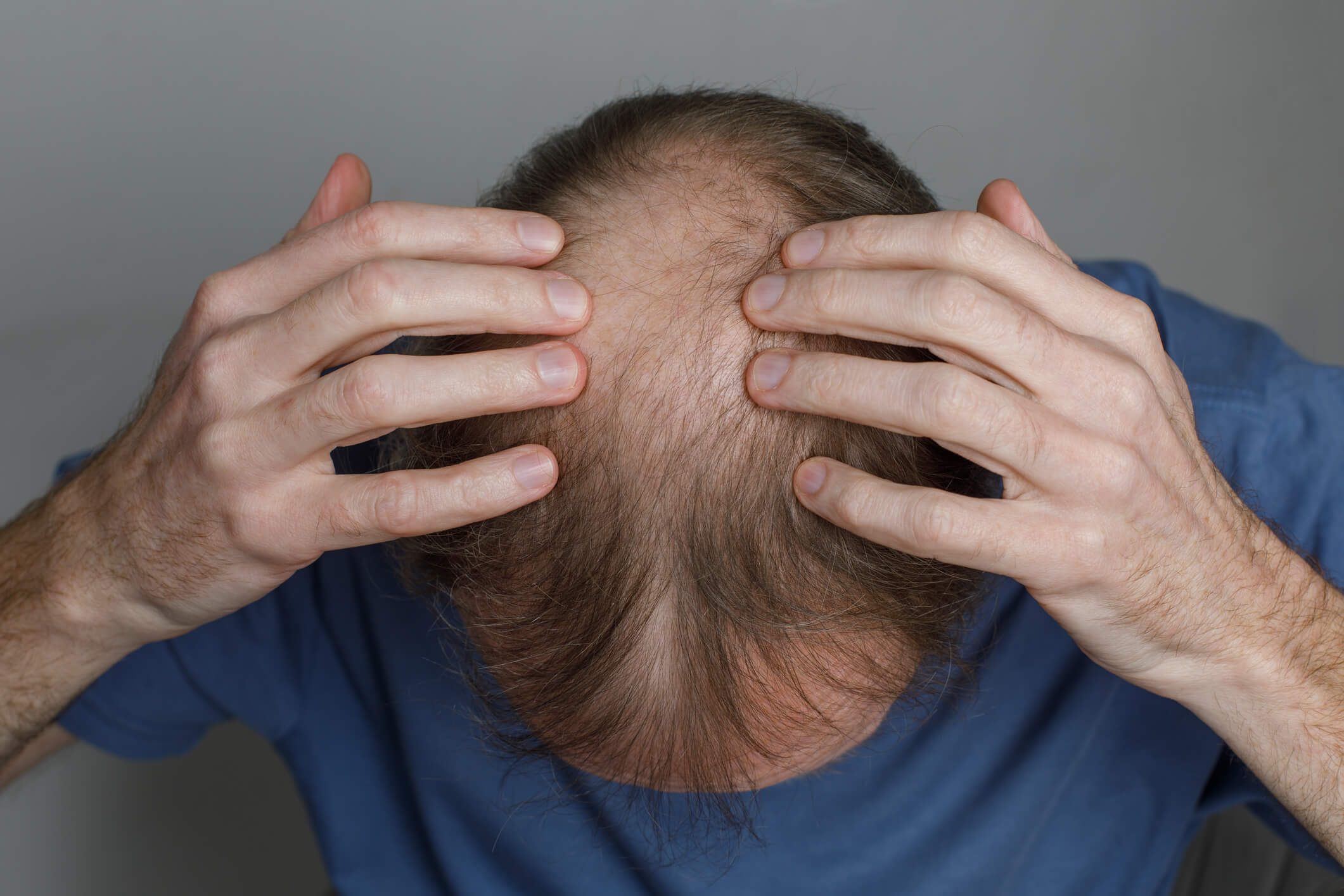 Treatment Options for Receding Hairlines 