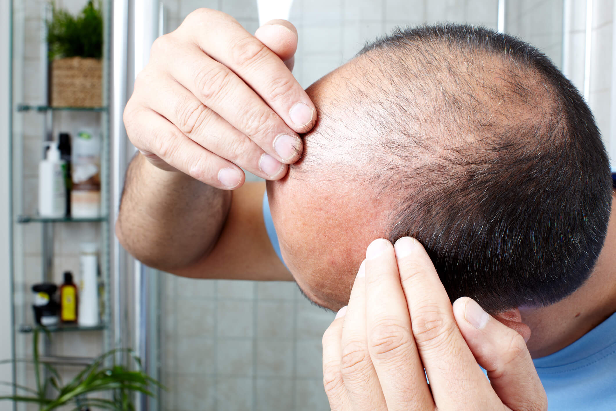 A patient who is taking metfomin examines his hair loss in Newport Beach, California at Neograft Hair Restoration Orange County clinic