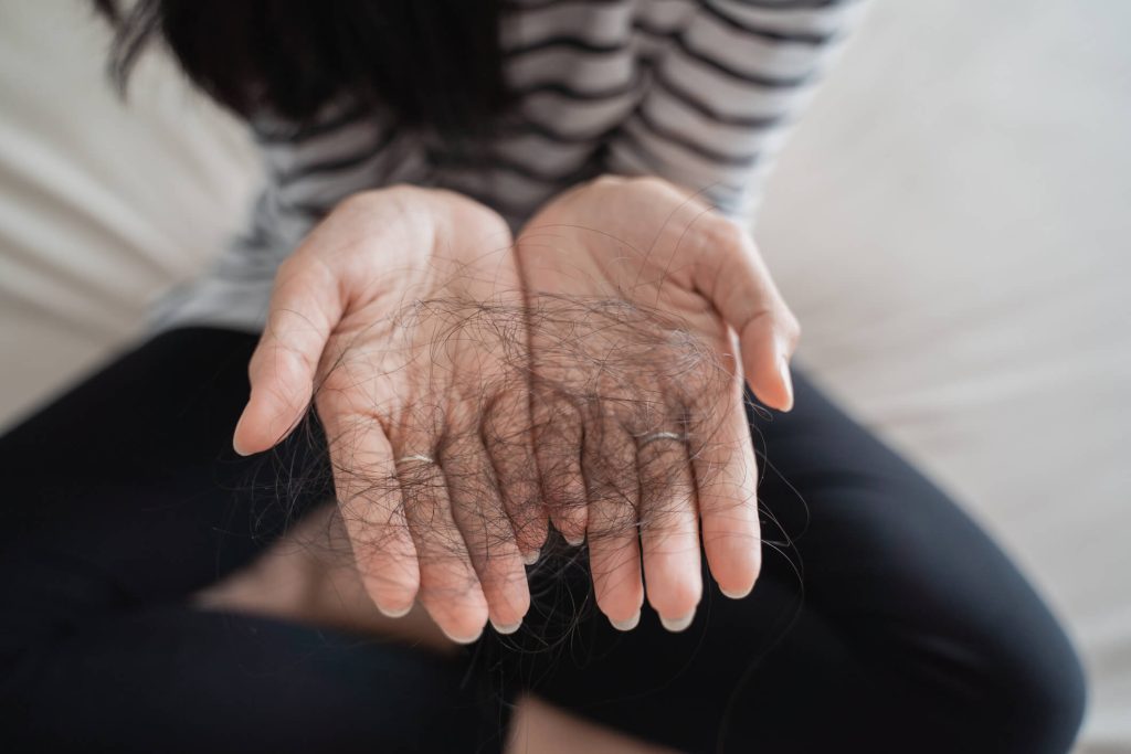 Person holding a clump of hair in their open hands, wearing a striped shirt and black pants, pondering the question: "Does Spironolactone cause hair loss?